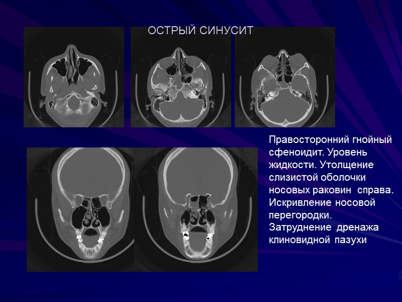 Правосторонний гнойный сфеноидит. Уровень жидкости. Утолщение слизистой оболочки носовых раковин  справа. Искривление носовой